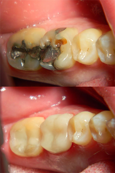 tooth_colored_fillings